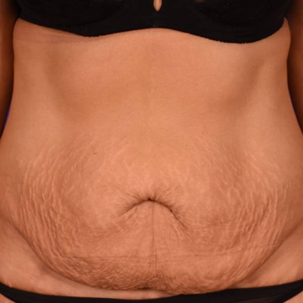before Image